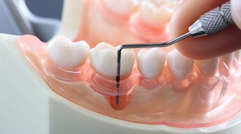 Процесс удаления зубного налета
