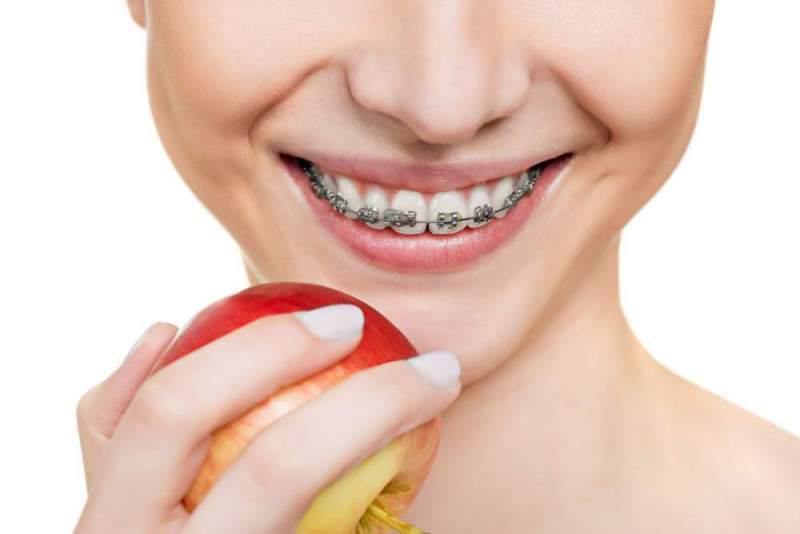 Особенности ортодонтического лечения зубов