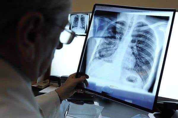 Заболеваемость туберкулезом в Тамбовской области на протяжении пяти лет остается ниже среднероссийского показателя 